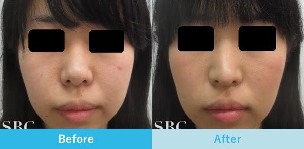 鼻孔縁下降術の症例写真3