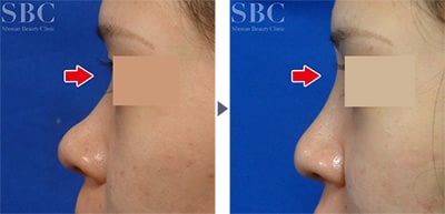 鼻根部から鼻背にかけてプロテーゼを入れる