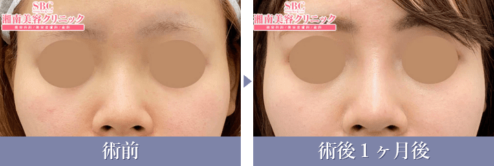 SBCプレミアムソフトプロテーゼの症例写真{症例296516}