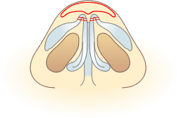 ④左右の大鼻翼軟骨を縫い寄せ、細い鼻尖を形成します。