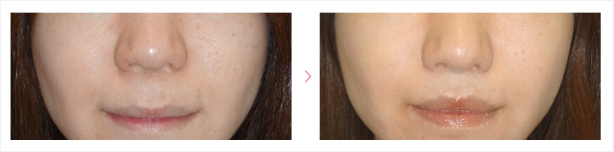 人中短縮（リップリフト）　症例写真　ビフォーアフター