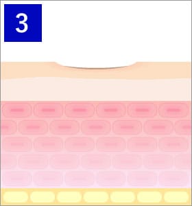 炭酸ガスレーザーのメカニズム3