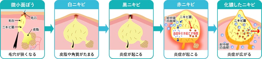 ニキビができるしくみと悪化する流れ イメージ3