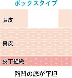 ボックスタイプ