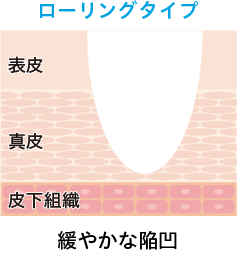 ローリングタイプ