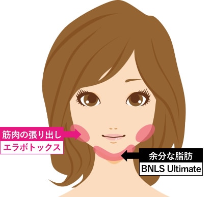 エラボトックス＋脂肪溶解注射 BNLS アルティメット（小顔注射）