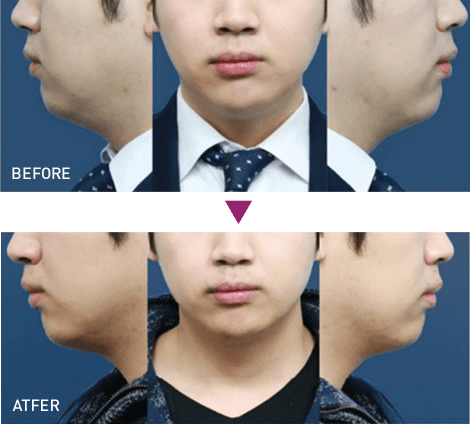 脂肪溶解注射 BNLS アルティメット（小顔注射）の症例写真3 ビフォーアフター