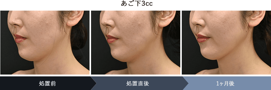FatX Coreの症例写真施術前後