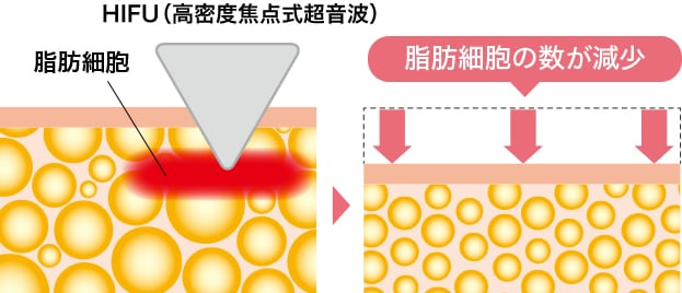 脂肪細胞減少のイメージ画像