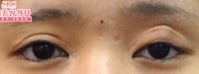 二重整形（他院修正）　症例写真　ビフォー①