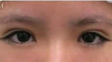 二重整形（他院修正）　症例写真　アフター③