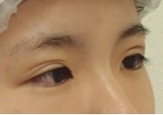 二重整形（他院修正）　症例写真　ビフォー④