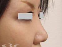 鼻整形（他院修正）　症例写真　アフター②