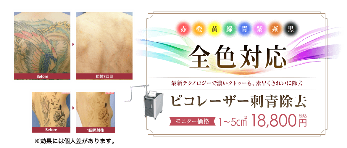 ピコレーザー刺青除去（エンライトンⅢ／エンライトンSR／PQXピコレーザー）