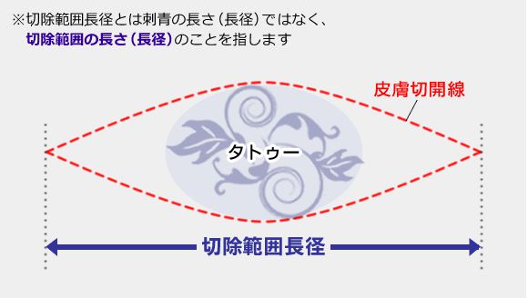 切除版の説明図