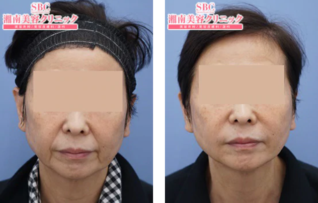 名倉俊輔医師|シルキーリフト|施術前後の症例写真