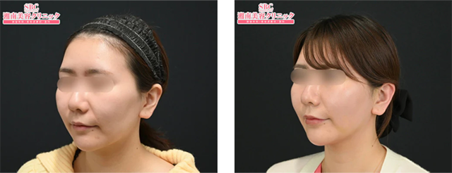 森脇大貴医師|シークレットリフト、ヒアルロン酸、VOV(ボブ)リフト|施術前後の症例写真